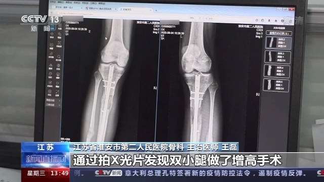 |在国外做断骨增高手术感染，22岁患者恐终身残疾