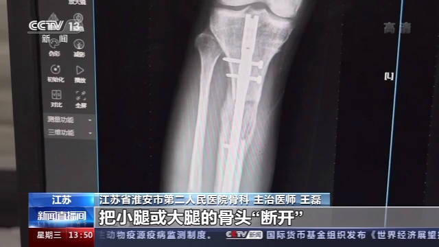 |在国外做断骨增高手术感染，22岁患者恐终身残疾