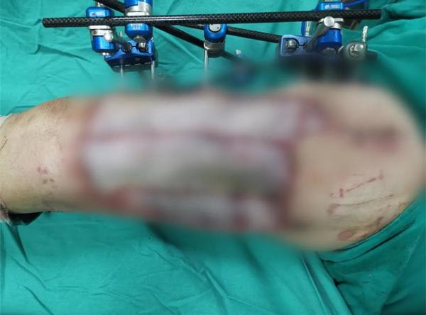 |仅一秒，手机突然变“手雷”！安阳一男子将手机放裤兜，险些炸断腿